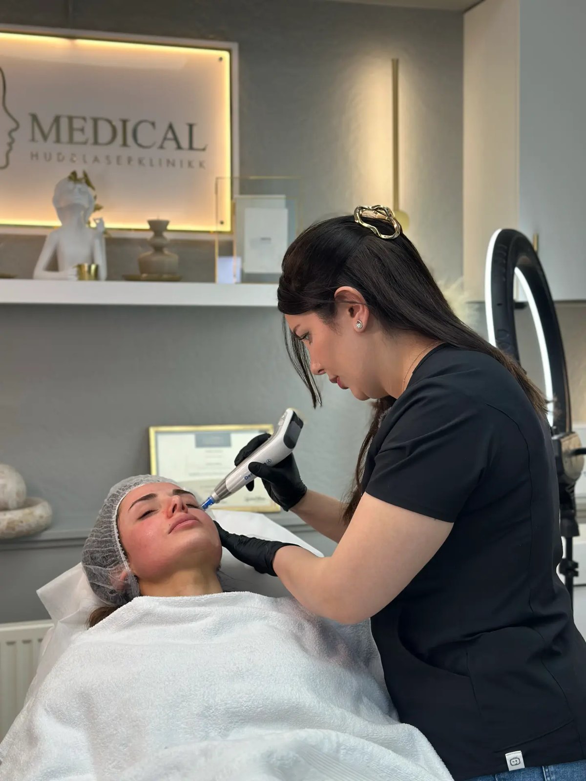 Microneedling langs kjeve og kinn